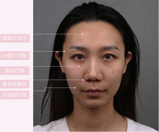 郑楚蓉院长ART技术 自体脂肪全脸填充