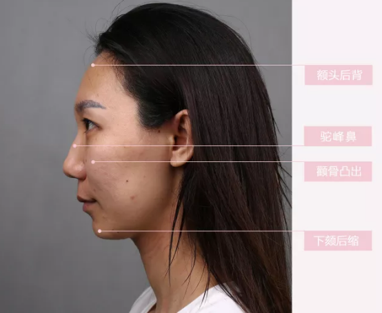 郑楚蓉院长ART技术 自体脂肪全脸填充