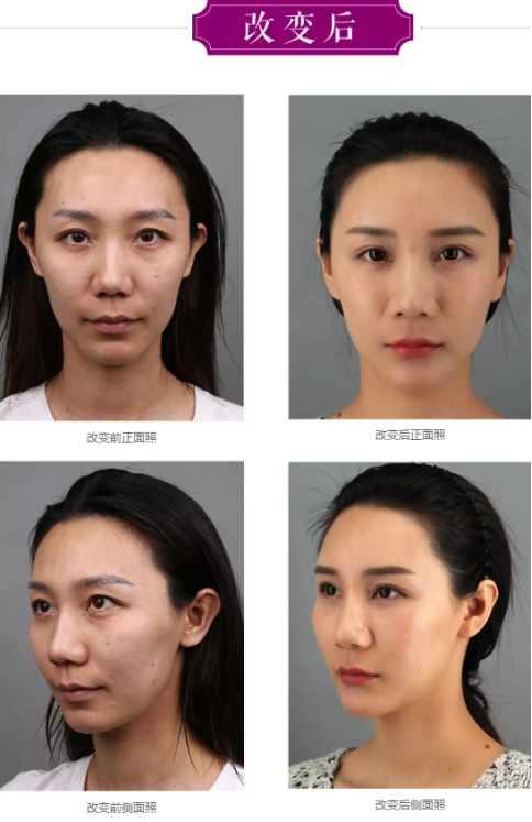 为变温柔做整形,全脸设计自己来