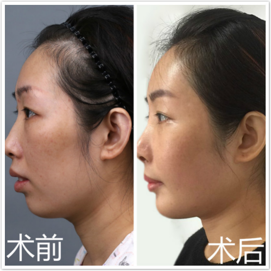 明郑楚蓉教授分享:嘴凸的女人如何变身侧颜杀