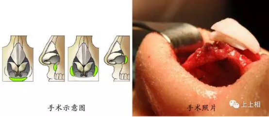 小手术、大效果-自体脂肪移植的ART技术