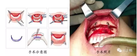 小手术、大效果-自体脂肪移植的ART技术