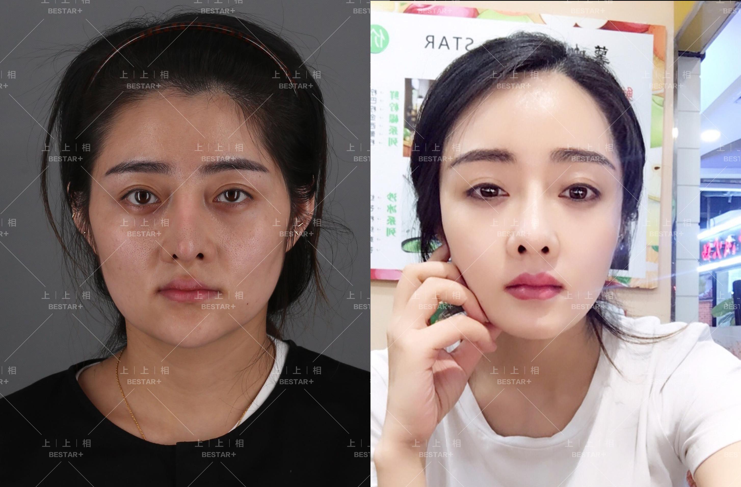 郑楚蓉院长告诉你面部脂肪移植的注意事项