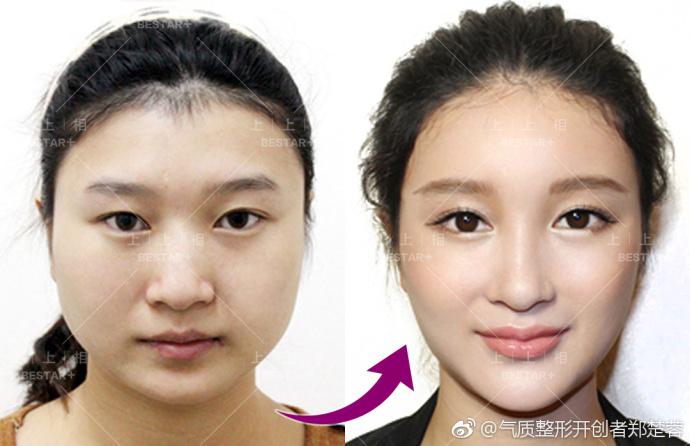 上上相自体脂肪填充额头怎么样
