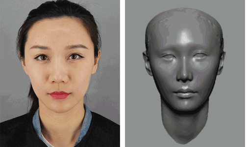 郑楚蓉院长ART技术 自体脂肪全脸填充