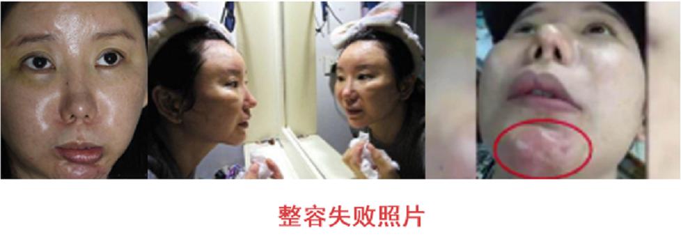 隆鼻多少钱?北京隆鼻价格